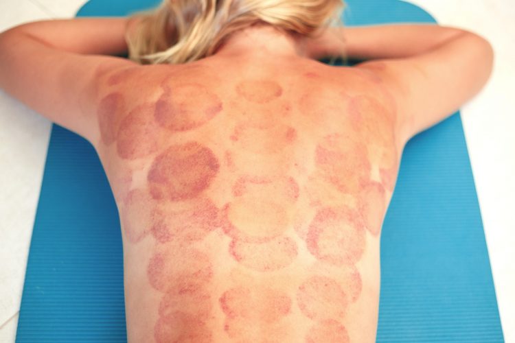 young woman with traces of vacuum cupping massage on her back